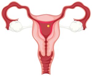 heavy menses