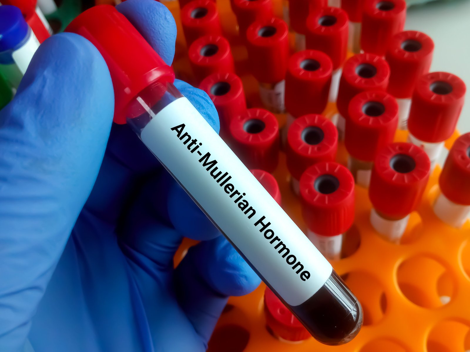 High AMH and fertility, AMH level and PCOS, Ovarian reserve